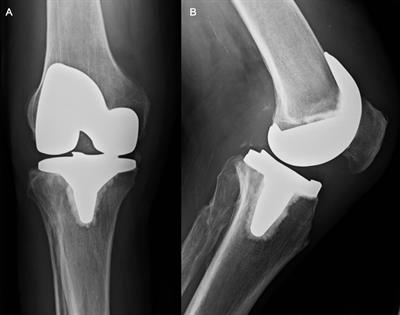 Therapy of chronic extensor mechanism deficiency after total knee arthroplasty using a monofilament polypropylene mesh